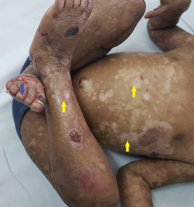 Multiple hypopigmented macules and atrophic scars (yellow arrows), and loss of nails (blue arrow).